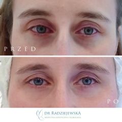 Korekcja doliny łez - efekty