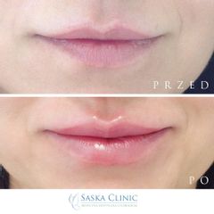 delikatne powiększenie ust wraz z korektą asymetrii