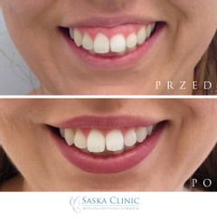 Uśmiech dziąsłowy tzw. gummy smile