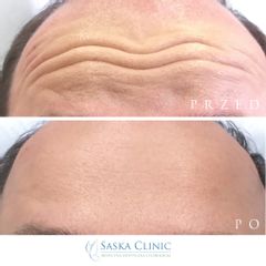 Redukcja zmarszczek poprzecznych czoła