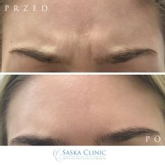 Toksyna botulinowa - lwia zmarszczka - Dr Iwona Radziejewska-Choma