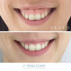 Toksyna botulinowa - gummy smile - Dr Iwona Radziejewska-Choma