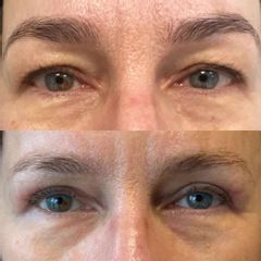 Plastyka powiek górnych dr Lepska