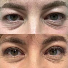 Plastyka powiek górnych dr Lepska