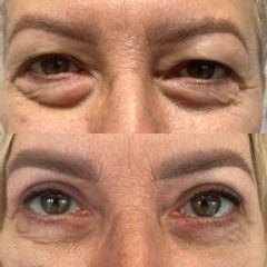 Plastyka powiek górnych i dolnych  dr Lepska