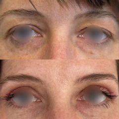 Plastyka powiek górnych dr Lepska