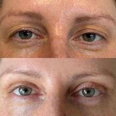 Plastyka powiek górnych dr Lepska