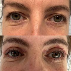 Plastyka powiek górnych dr Lepska