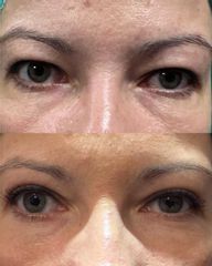 Plastyka powiek górnych dr Lepska