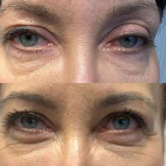 Korekcja ptozy - Dr Katarzyna Lepska