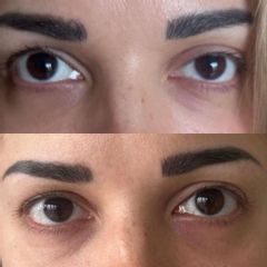 Korekcja ptozy Dr Katarzyna Lepska