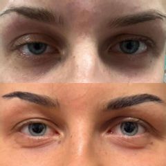 Korekcja ptozy Dr Katarzyna Lepska