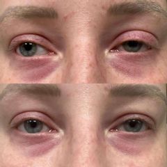Korekcja ptozy Dr Katarzyna Lepska