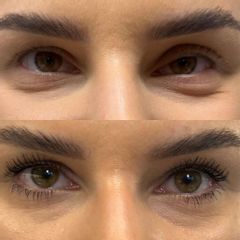 Korekcja ptozy Dr Katarzyna Lepska