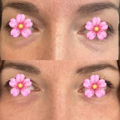 Korekcja powiek Dr Katarzyna Lepska