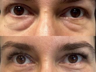 Blefaroplastyka przed i po - 877436