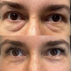 Efekt po przespojowkowej plastyce powiek dolnych