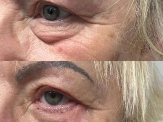 Blefaroplastyka przed i po - 877437