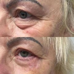 Efekt po przespojowkowej plastyce powiek górnych