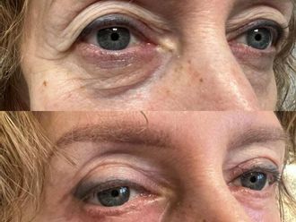 Blefaroplastyka przed i po - 877438