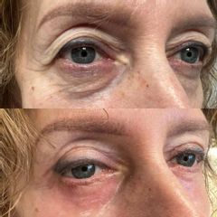 Efekt po przespojowkowej plastyce powiek dolnych