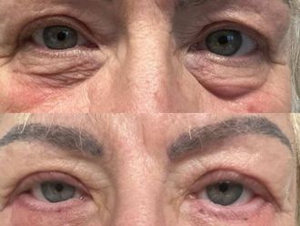 Blefaroplastyka przed i po - 877447