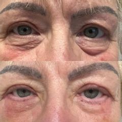 Efekt przed i po plastyce powiek górnych