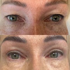 Efekt przed i po plastyce powiek górnych