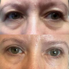 Efekt przed i po plastyce powiek górnych
