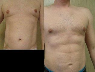 Liposukcja Vaser Lipo: przed i po