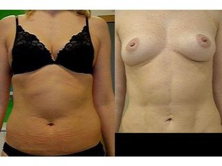 Liposukcja Vaser Lipo - przed i po