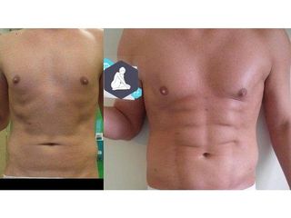 Liposukcja Vaser Lipo - przed i po