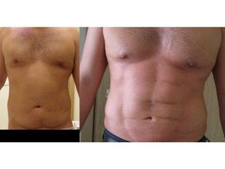 Liposukcja Vaser Lipo - przed i po