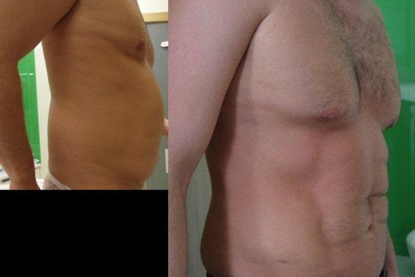 Liposukcja ultradźwiękowa przed i po - 686716