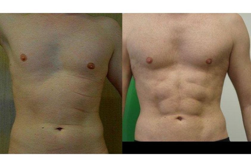 Liposukcja ultradźwiękowa przed i po - 686717