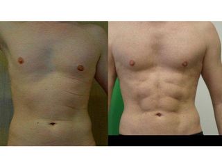 Liposukcja  Vaser Lipo - przed i po