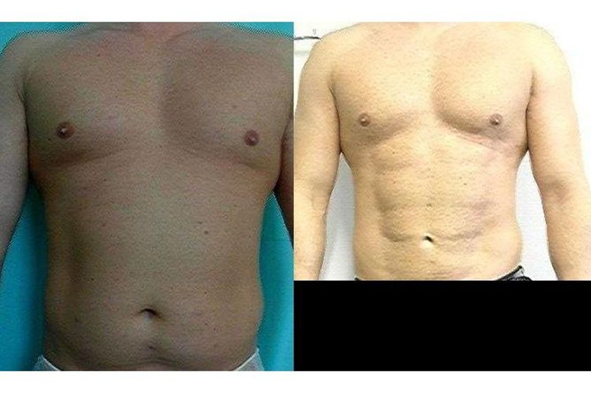 Liposukcja ultradźwiękowa przed i po - 686718