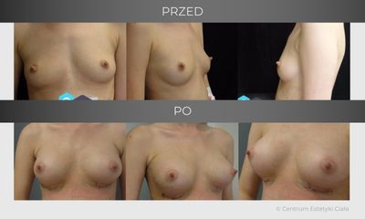 Powiększanie biustu - przed i po