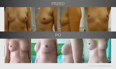 Powiększanie biustu - przed i po