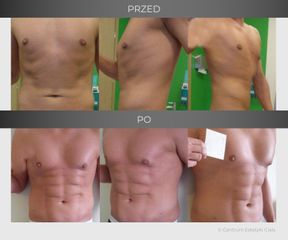 Liposukcja Vaser Lipo - przed i po