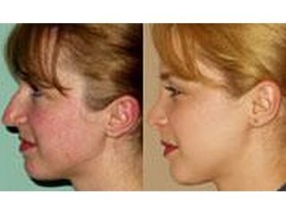 Korekta nosa - przed i po