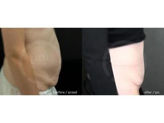 Plastyka brzucha (abdominoplastyka) - przed i po