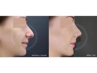 Korekta nosa - przed i po. Klinika Timeless