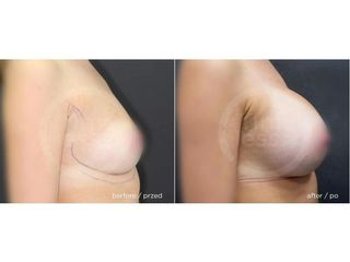Powiększanie piersi implantami endoskopowo - przed i po