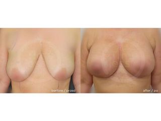 Mastopeksja i powiększenie implantami - przed i po