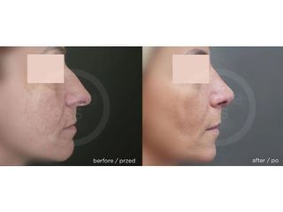 Korekta nosa - przed i po