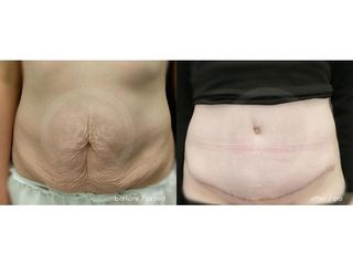 Plastyka brzucha (abdominoplastyka) - przed i po