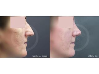 Korekta nosa - przed i po. Klinika Timeless.