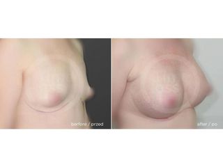 Powiększanie piersi implantami podmięśniowo - przed i po