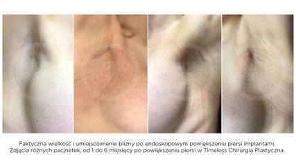 Blizna po powiększeniu piersi metodą endoskopową